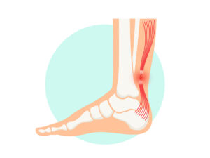 Achilles tendon rupture anatomical poster. Ankle injury, ligament sprain and tear problems