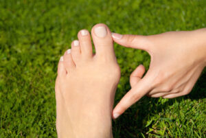 Hallux valgus, bunion in foot on grass background